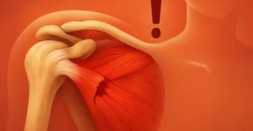 Ruptura do Manguito Rotador: Diagnóstico e Opções de Tratamento